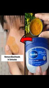 Remove Blackheads At Home Easily - Get Rid Of Blackheads & Whiteheads | Simple Home Remedies