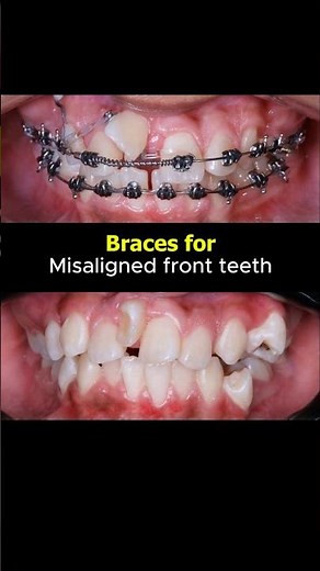 Braces transformation. Fix extremely misaligned front teeth #braces #dentist #orthodontist #teeth