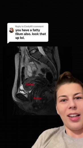 Replying to @CindyM MRI technologists teach me! Ive learned 5% of people have fatty filum terminale most of which are asymptomatic but some have tethered cord syndrome (more common in hypermobile ehlers danlos syndrome) Where the spinal cord is abnormally stretched or tethered due to the filum terminale being too thick causing lower back pain, weakness or numbness in the legs and bladder or bowel dysfunction.