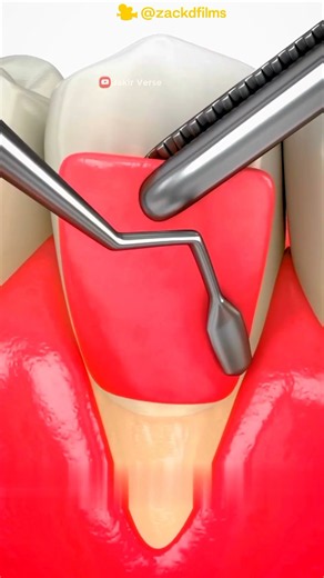 🦷 How Gum Grafts Fix Receding Gums and Protect Teeth! 🪥 #Health #Dentistry #Medical