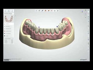 Novaloc® Digital – How to do the Implant Level Design?