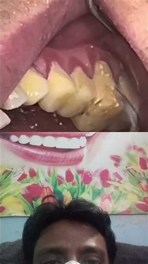 Calculus with gum infection #dentist #dentalcost