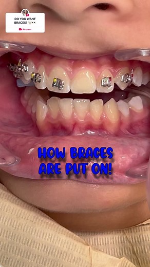 What to Expect When Getting Braces