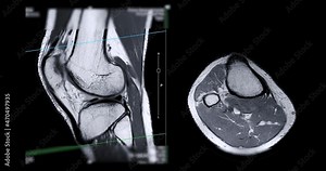 MRI knee or Magnetic resonance imaging of knee joint for detect acl ligament tear.