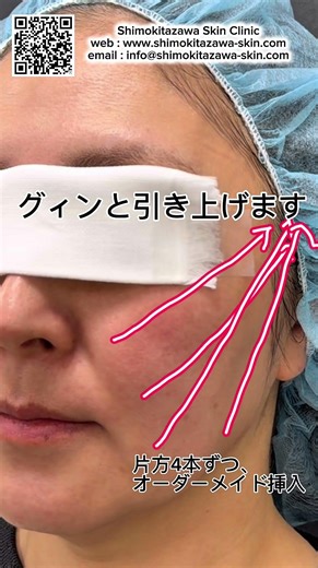 シモキタリフトで若返り！