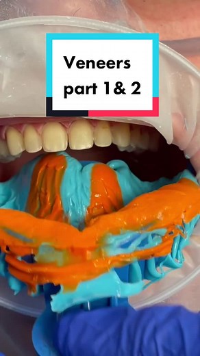 #veneers #start #to #finish #procedure #beforeandafter #veneersjourney #drtejaspatel #cosmetics #dental #teeth #smiley
