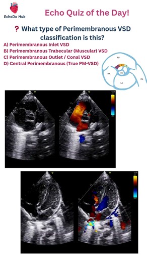 What type of Perimembranous VSD classification is this? #echocardiography