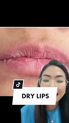 Dry and Chapped Lips: Causes and Solutions
