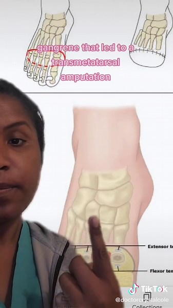 Understanding Transmetatarsal Amputation Procedures