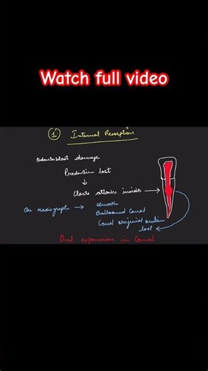 Internal vs External Root resorption | Quick Revision #dentistry