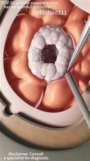 Craniotomy Brain Surgery (3D Animation)#craniotomy #craniotomysurgery #brainsurgery#braintumor