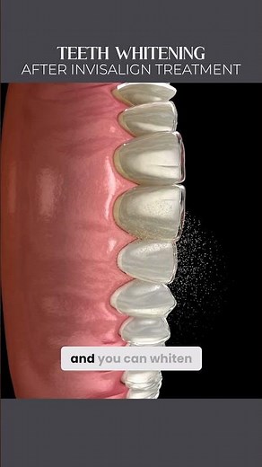 Teeth Whitening After Invisalign