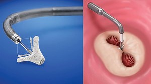 Advanced Treatment Options for Heart Valve Disease