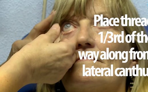 OT skills guide：phenol red thread - 酚红棉线试验