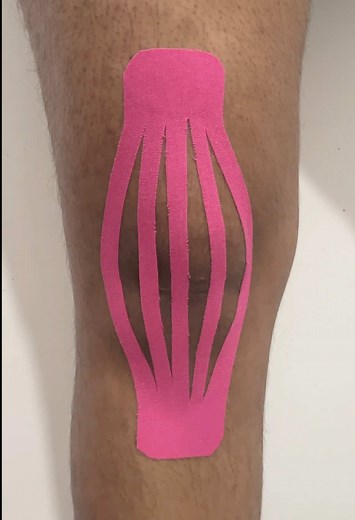 Knee Swelling Taping #KinesiologyTaping #Physiotherapy #PainRelief #InjuryRecovery #SportsInjury