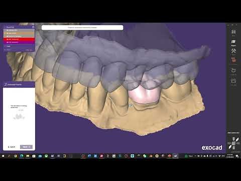 Basic single crown design with Exocad