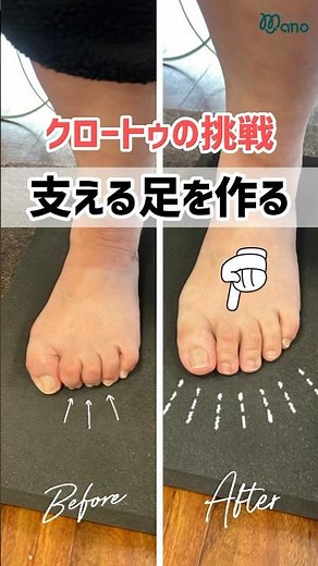 足指が丸まる現象、クロートゥ🦶足底がしっかりつけば、バランスも改善しますね😊 #片麻痺 #lリハビリ #リハビリ後 #埼玉県 #脳梗塞 #脳出血