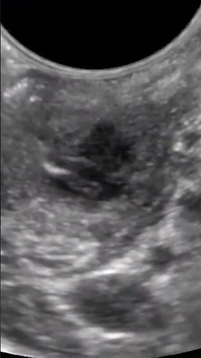 Draining Peritonsillar Abscess with #POCUS