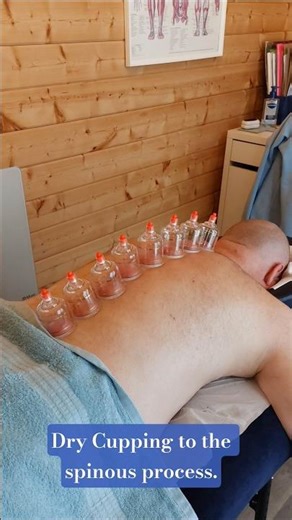 Dry Cupping to the spinous process for the ultimate decompression. #sportsmassage #massage