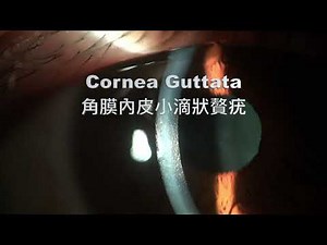 Cornea guttata