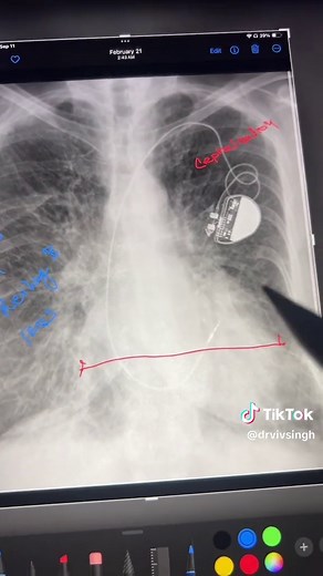 How to Spot Pulmonary Edema in Chest X-Rays