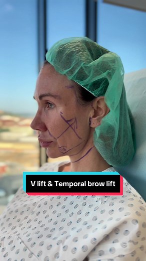 V Lift and Temporal Brow Lift: Healing Progress