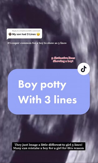 Understanding Gender Reveal Ultrasound: 3 Lines Boy, Girl Examples