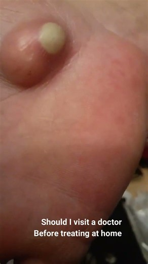 Should I visit a doctor, Before treating at home