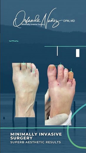Elongated 2nd toe Deformed 4th toe - Minimally Invasive Surgery