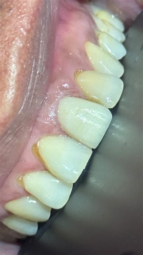 A dental cap or crown is highly recommended after root canal treatment to achieve a long-term proper seal thereby preventing re-infection. #taguigdentist #dentalclinicintaguig #dentalclinicnearme #taguigpaterosdentalclinic #paterosdentalclinic | G.O. Dental Clinic - Taguig City