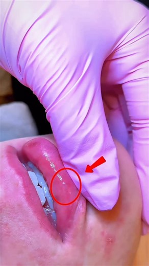 Botox | Filler | Skin Rejuvenation | Laser on Instagram: "‼️ Assess BEFORE you inject ‼️ That pulsating bulge is the inferior labial artery — a branch of the facial artery that supplies blood to the lower lip and surrounding perioral tissues. On this patient, the artery runs more superficially than average which is why a full assessment is critical before choosing depth and technique! Assessing lip anatomy before injecting is essential. Every patient is unique, and understanding their individual