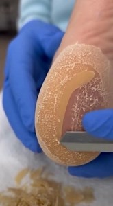 Satisfying Dead Skin & Callus Removal footpeel #removal | Village Videos