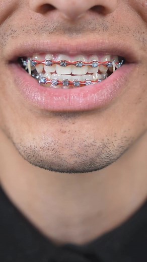 Understanding the Pain of Braces: What to Expect