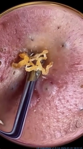 Understanding Pimple Pop Techniques for Clear Skin