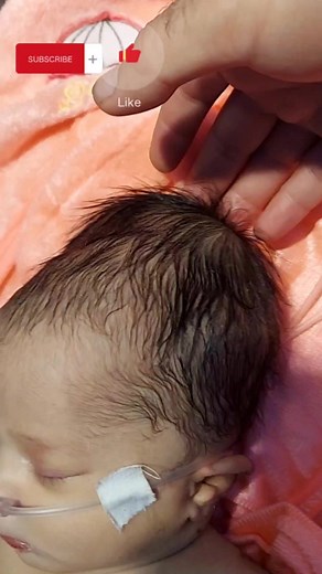 Understanding Caput Succedaneum in Newborns