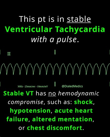 Understanding Stable Monomorphic Ventricular Tachycardia on ECG Recordings