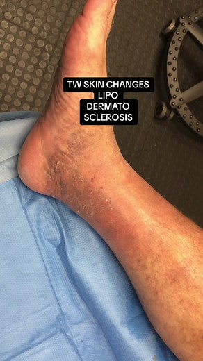 LIPO = FAT DERM = SKIN SCLEROSIS = INDURATION Can result from elevated pressure or reflux in the superficial veins of the legs. #lipodermatosclerosis #varicoseveins #sclerotherapy #legswelling #DVT #venousdisease #legpain #drstoffey #drbonavita #phoenix #chandler #scottsdale #venaseal #ankleswelling #veindoc