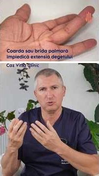 Symptoms of Dupuytren's disease