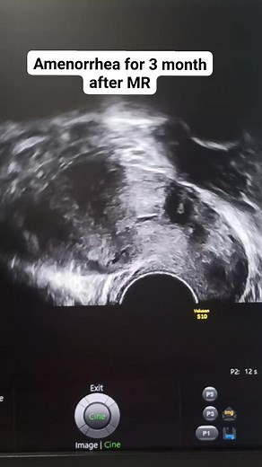 #sonographiccasestudy #radiology #sonography #learning #reelsfacebook #reelsvideo | Sonographic case study