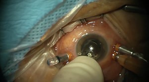 Rivals of Retina | Eyetube