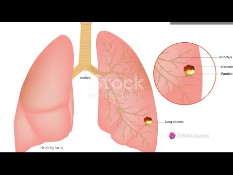 Lung Abscess: A Deep Dive into the Pus-filled Cavity. New Video Series