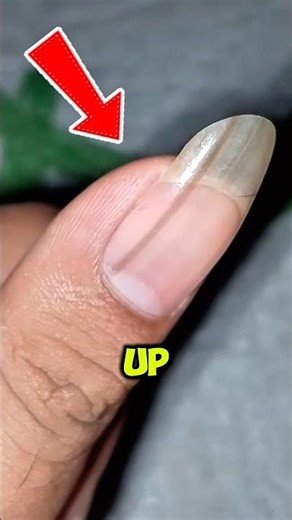 The Dark Line on Your Nail You Should NEVER Ignore 😨