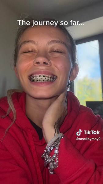 4 Month Brace Progress: Journey to Straight Teeth