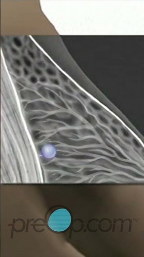 Breast Biopsy Wire Localization: Step-by-Step Guide 🏥 🎥 #PreOp #Shorts #BreastBiopsy Pt. 2