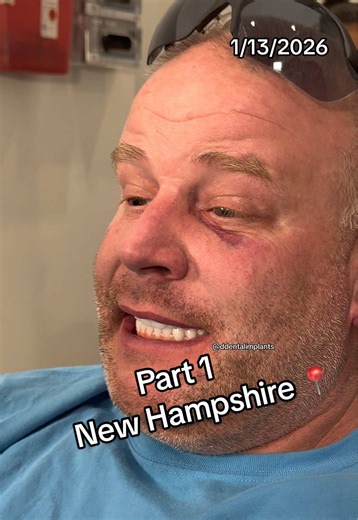 Part 1 | Patient from New Hampshire📍 All-on-4 implants 🦷 Permanent zirconia teeth in 24 HOURS 😮 Adjusted before flying home Full mouth starting at $32,000 usd #AllOn4 #DentalImplants #transformationchallenge #LIVEIsEasy