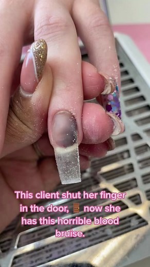 Dealing with Nail Bruises: What You Need to Know