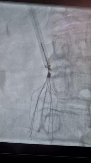 FilterOut 3...IVC filter retrieval Denali from BARD