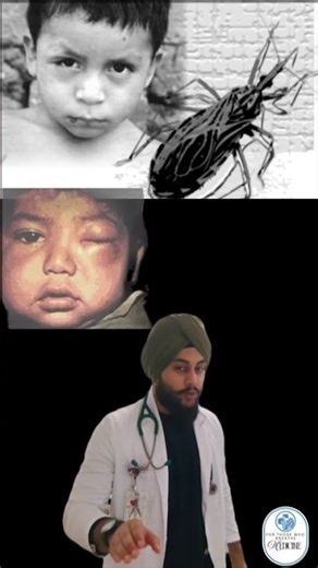 "Chagas Disease" #boardreview #clinicalcases #inicet #diseases #fmge #medicine