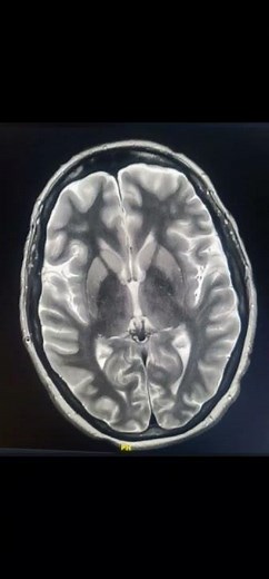 Creutzfeldt-Jakob Disease #mri #cjd