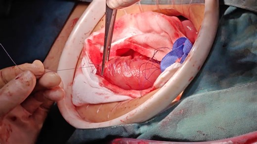 标准肠肠吻合手术 院士级别专家手术 推荐☆☆☆☆☆